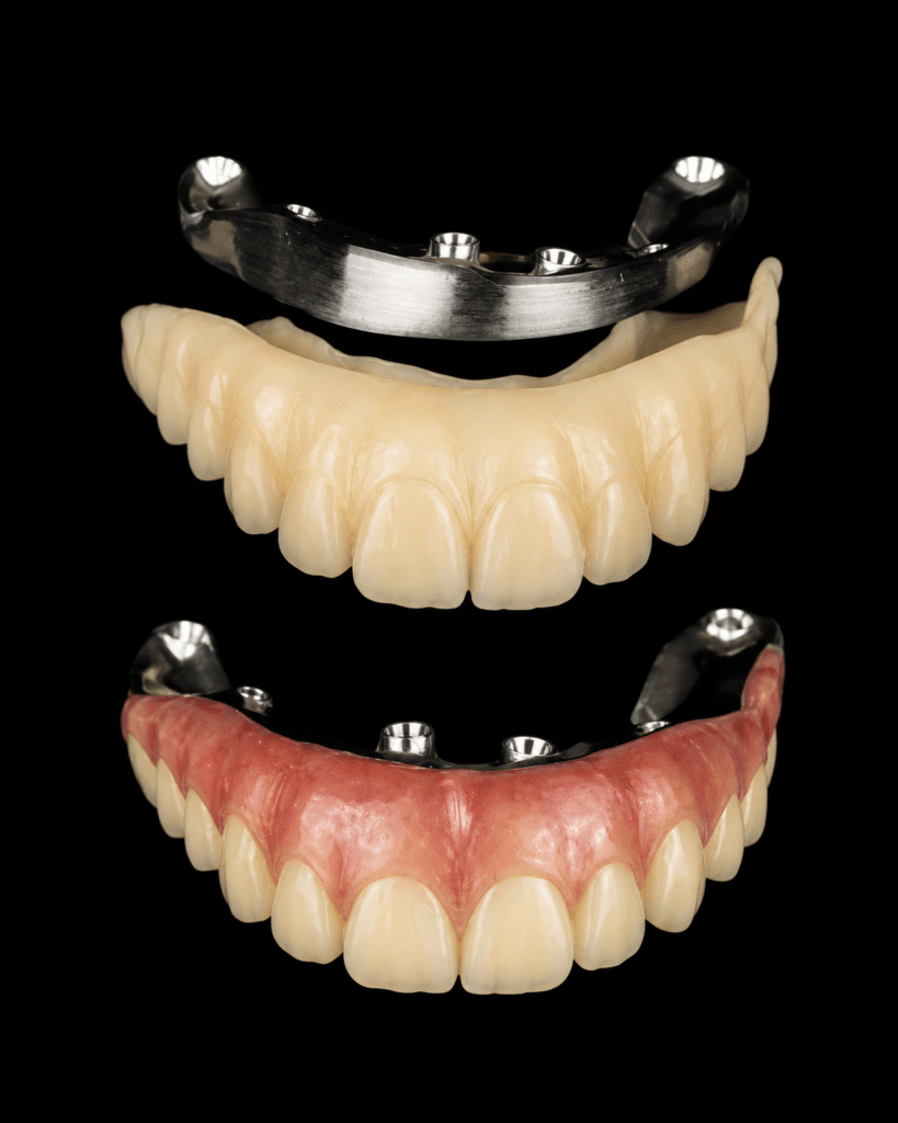 Imagem atual: Prótese protocolo fresada em resina ou zircônia planejada digitalmente na Freitas Odontologia em Campinas com Dr. Caio Peixoto.