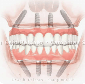 Consulta para avaliar implante com carga imediata ou tratamento em etapas em Campinas com planejamento na Freitas Odontologia.