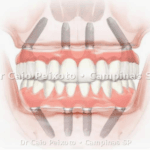 Imagem atual: All-on-4 ou All-on-6: planejamento com tomografia em Campinas