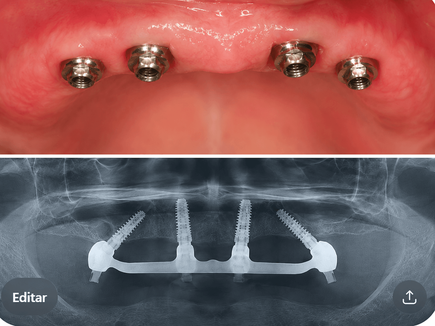 Paciente em adaptação ao protocolo dentário em Campinas na Freitas Odontologia com acompanhamento do Dr. Caio Peixoto.