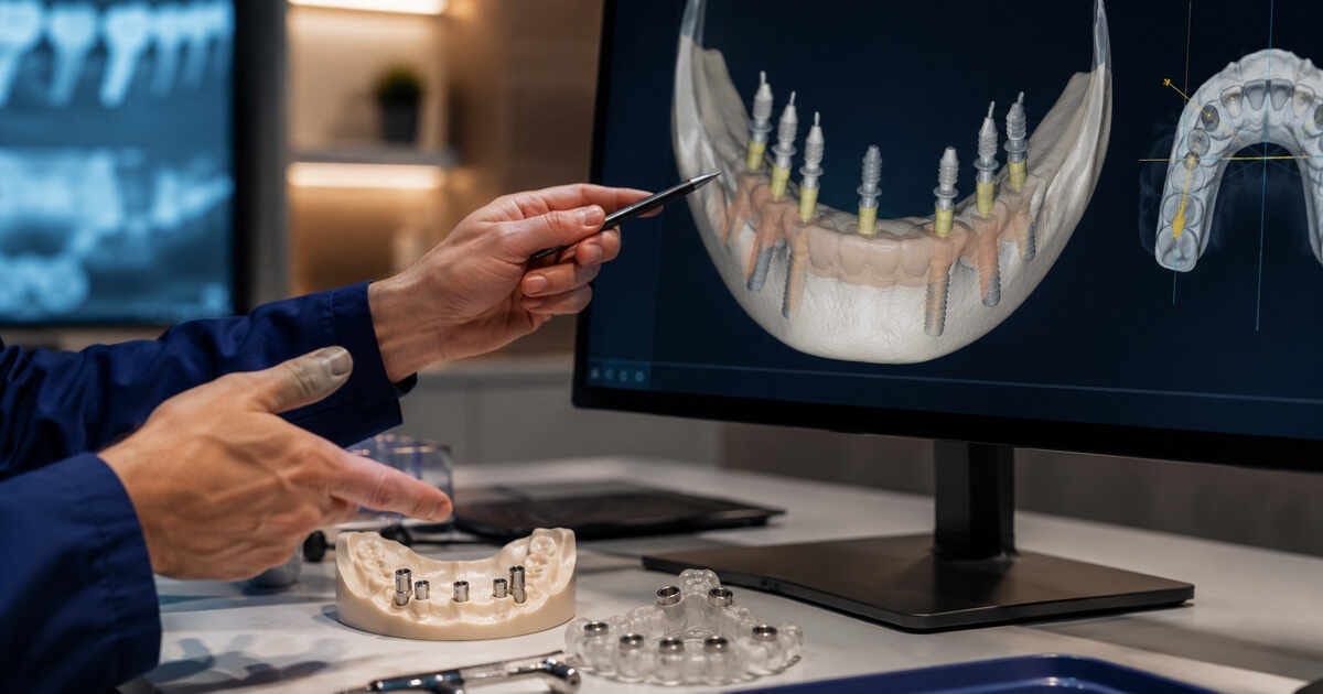 Planejamento digital para prótese protocolo fixa sobre implantes